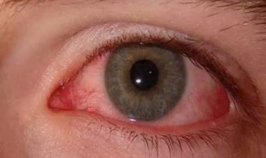 छत्तीसगढ़ में आई फ्लू के अब तक 19,873 मामले