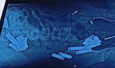 इस 9 वीं के बच्चे के पेट में मिला घड़ी में लगने वाले सेल, ब्लेड के टुकड़े सहित 56 सामान, नहीं बचा पाए डॉक्टर