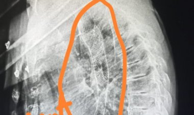 मरीज की गंगाजल पीने की इच्छा पूरी करने स्पर्श हॉस्पिटल भिलाई में हुआ सफल रिस्की ऑपरेशन